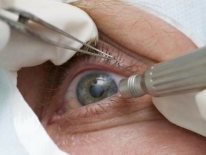 Pandemia x Glaucoma: entenda os efeitos que dificultam diagnóstico