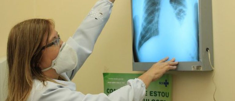 Tratamento de tuberculose terá novas diretrizes pelo SUS